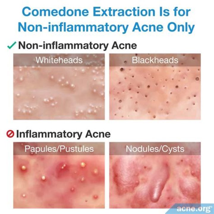 Are comedone extractors bad for your skin?