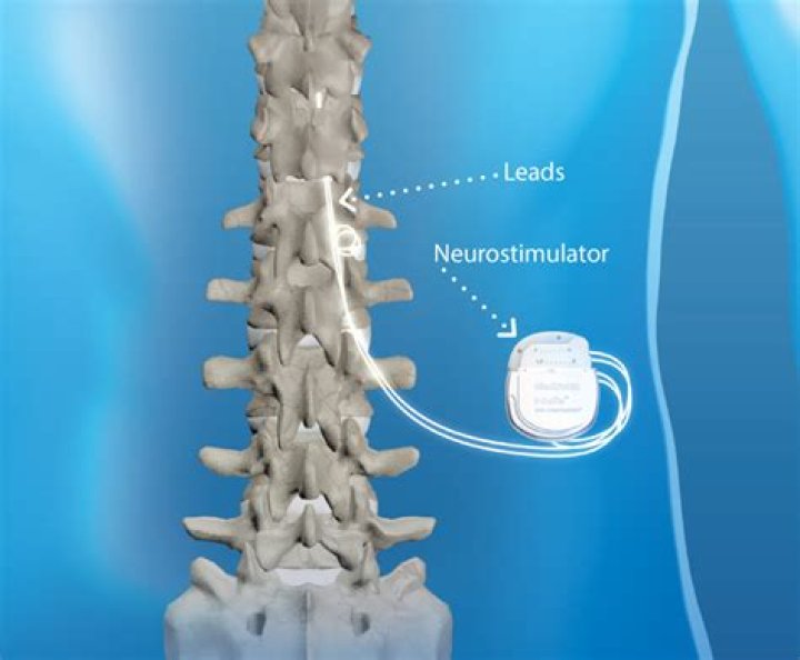 Are Medtronic spinal cord stimulators MRI compatible?