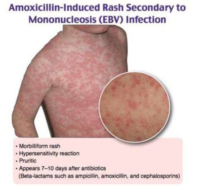 Can amoxicillin cause a rash after 7 days?