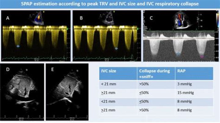 Can an echocardiogram detect pulmonary hypertension?