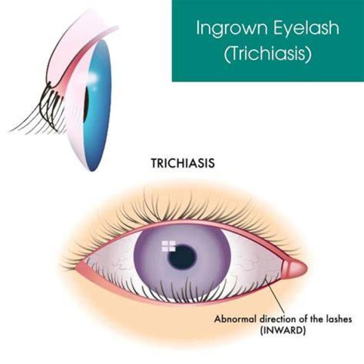 Can an optician remove an ingrown eyelash?