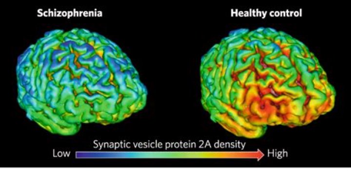 Can brain imaging detect schizophrenia?