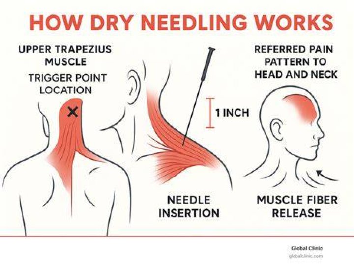 Can dry needling be done in the neck?