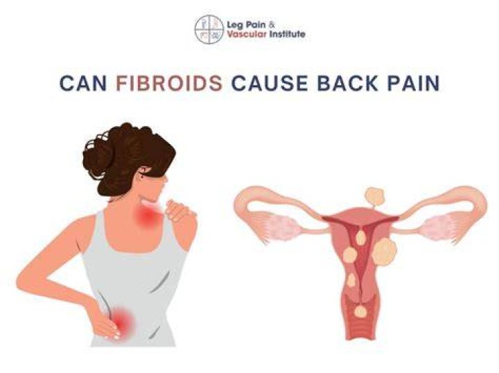 Can fibroids cause back pain and nausea?