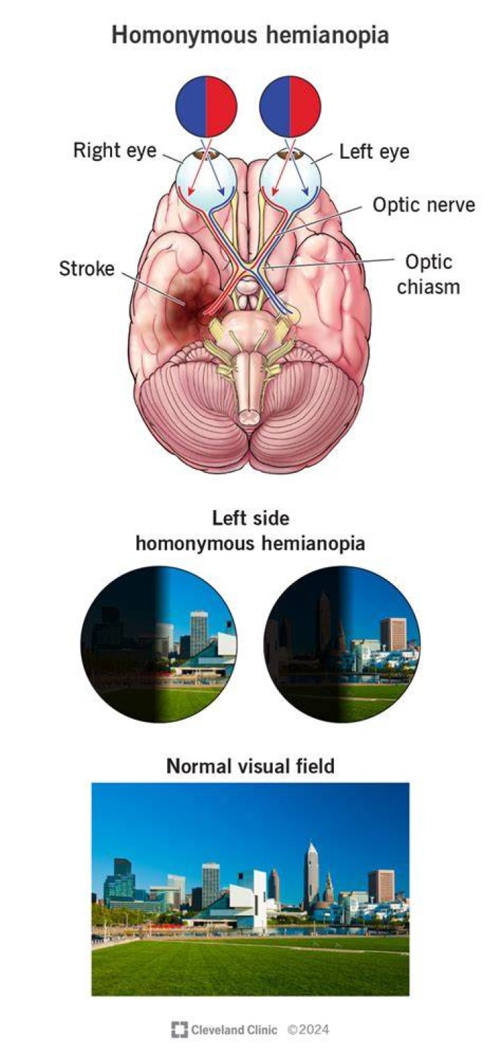 Can migraine cause homonymous hemianopia?