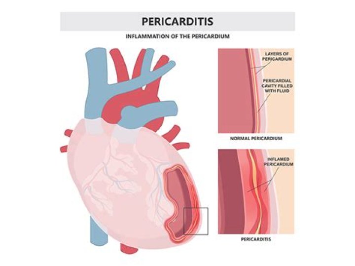 Can pericarditis be caused by lupus?