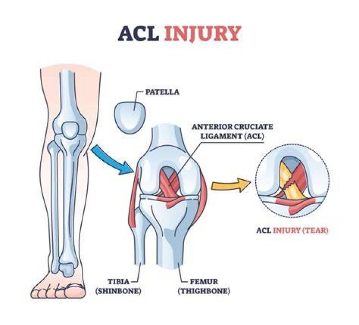 Can PRP heal a torn ACL?