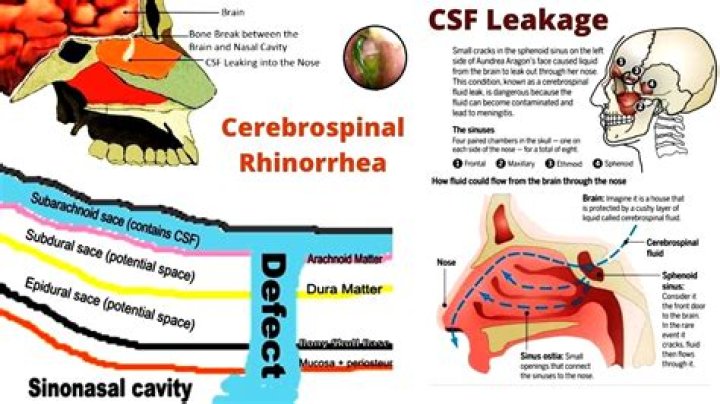 Can spinal fluid leak from nose?