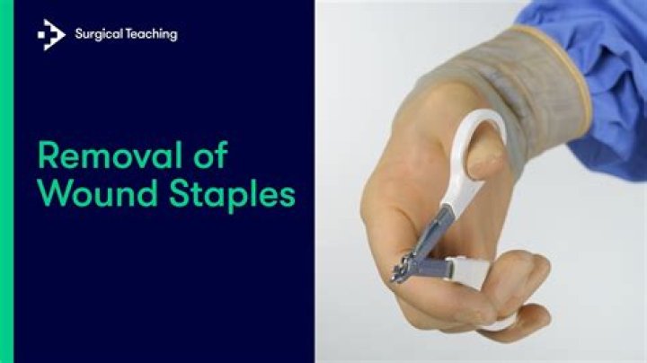 Can surgical staples cause pain?