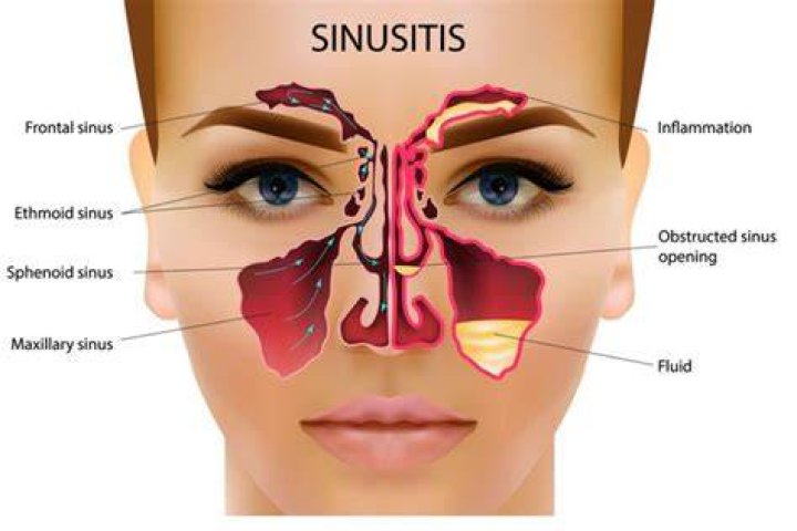 Can wood smoke cause sinus problems?
