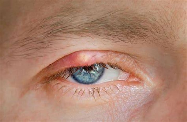 Can you get a growth on the inside of your eyelid?