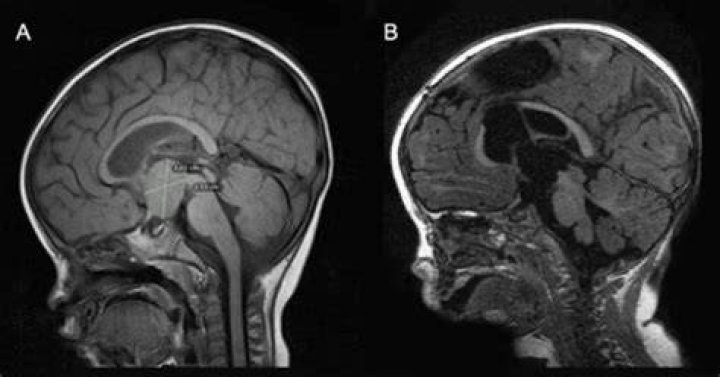 Do hypothalamic hamartomas grow?