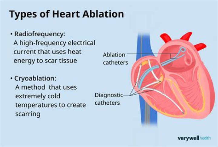 Does ablation help cardiomyopathy?