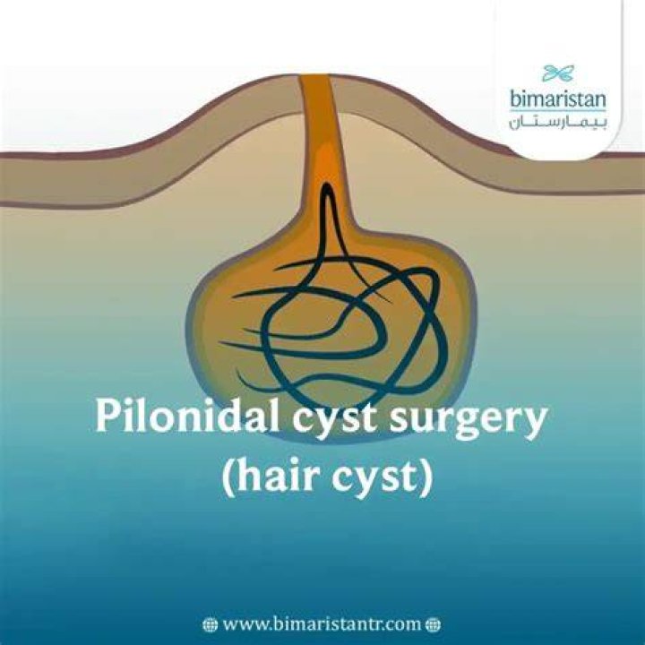 Does pilonidal cyst surgery leave a scar?