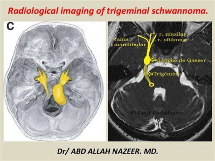 How common are trigeminal schwannomas?