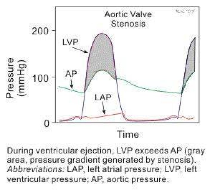 How do you calculate the aortic pressure gradient?