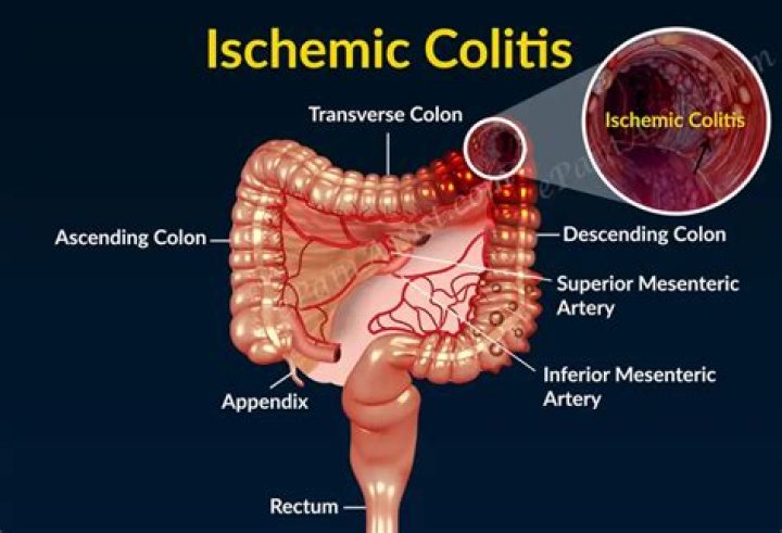 How do you diagnose ischemic colitis?