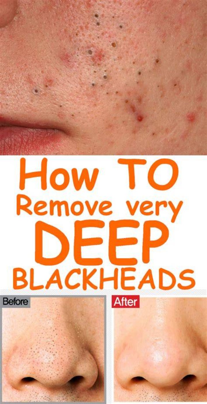How do you dissolve deep blackheads?