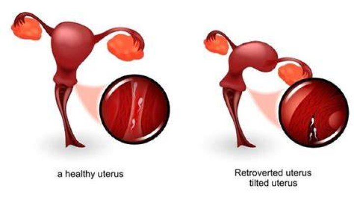 How do you fix a reverse uterus?