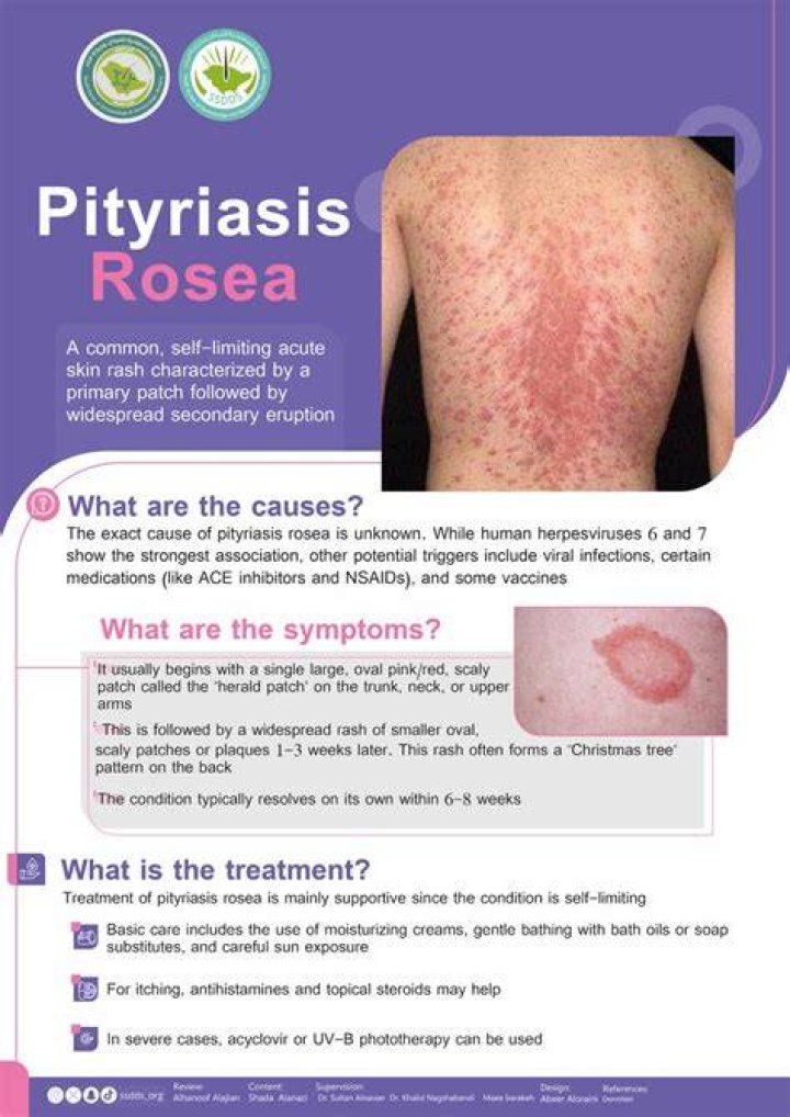 How do you know if pityriasis rosea is healing?