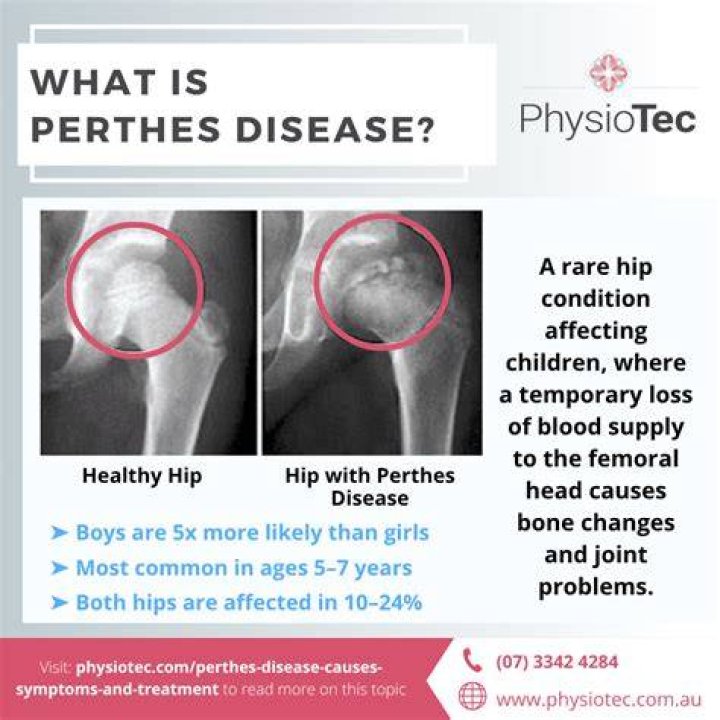 How do you manage Perthes disease?