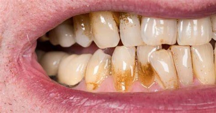 How do you remove brown stains from teeth?