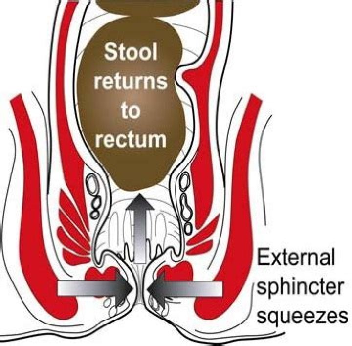 How do you strengthen your external sphincter?