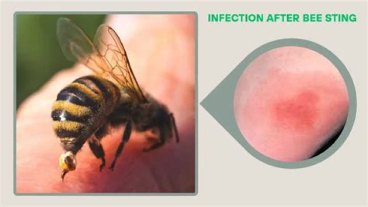 How do you tell if a bee stinger is still in your skin?