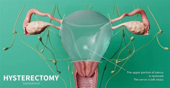 How long are you out of work for a hysterectomy?