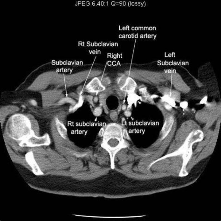 How long does a CT scan of the carotid artery take?
