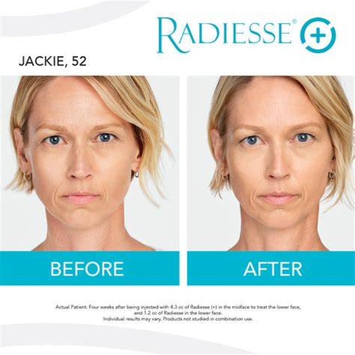 How long does bruising last after Radiesse?