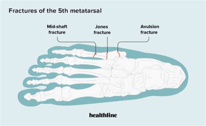 How long does it take for a nondisplaced metatarsal fracture to heal?