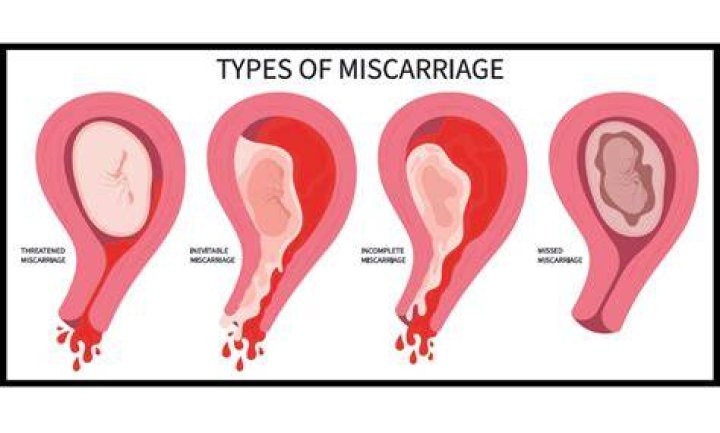 How long should I bleed for after a miscarriage?