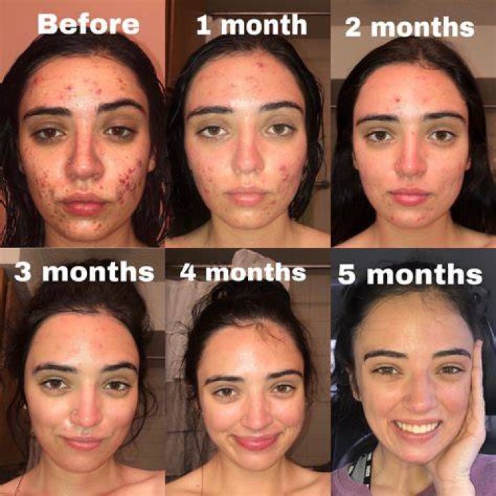Is 5 months on Accutane enough?