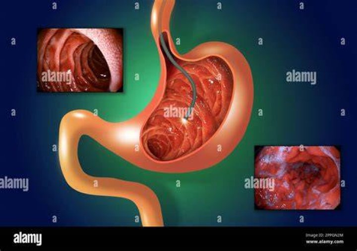 Is endoscopy of stomach painful?