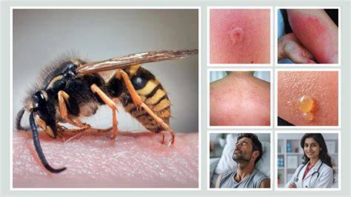Is it normal for a wasp sting to itch a week later?
