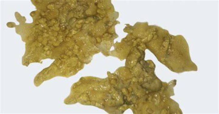 Is it normal for toddler to have undigested food in stool?