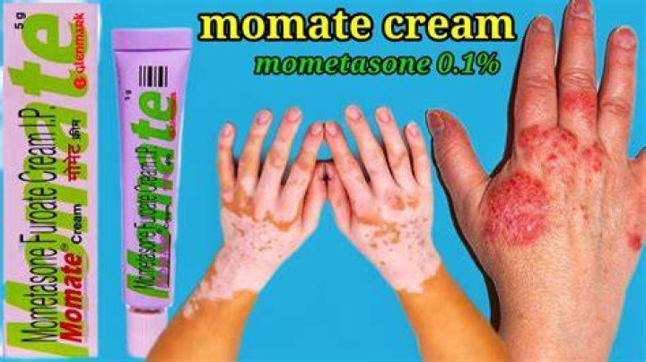 Is mometasone good for vitiligo?