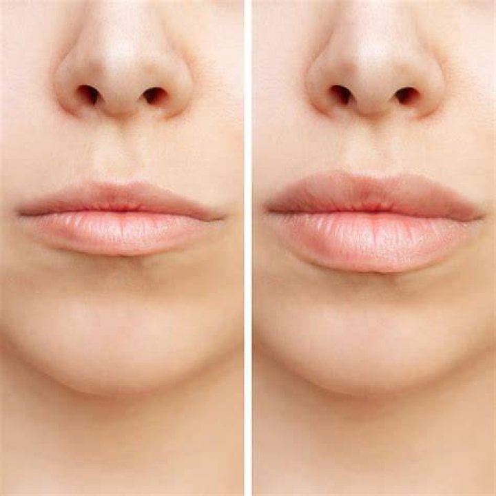 Is Volbella or Juvederm better for lips?