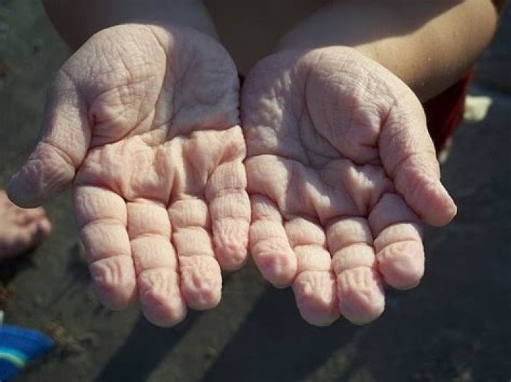 What are scrumpy hands?