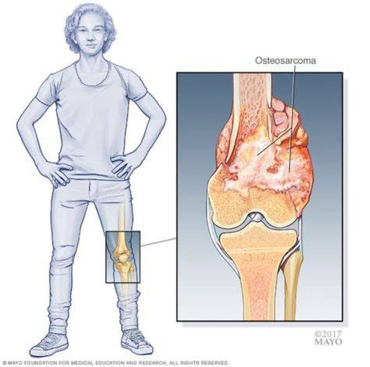 What are the most significant symptoms of osteosarcoma?