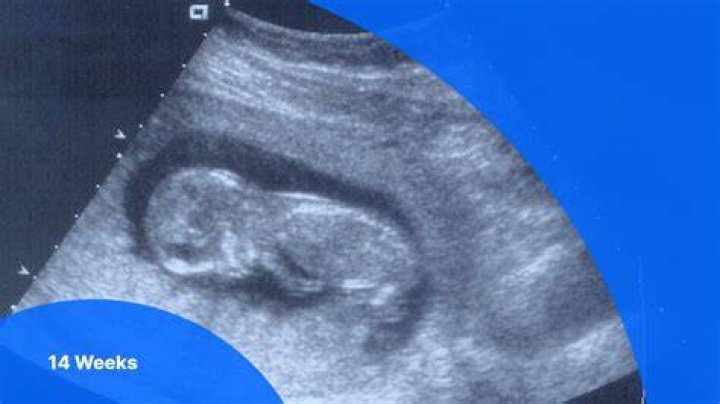 What can be seen on 14 week scan?