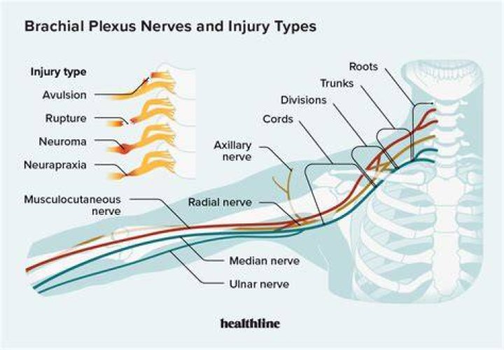 What causes brachial plexus neuropraxia?