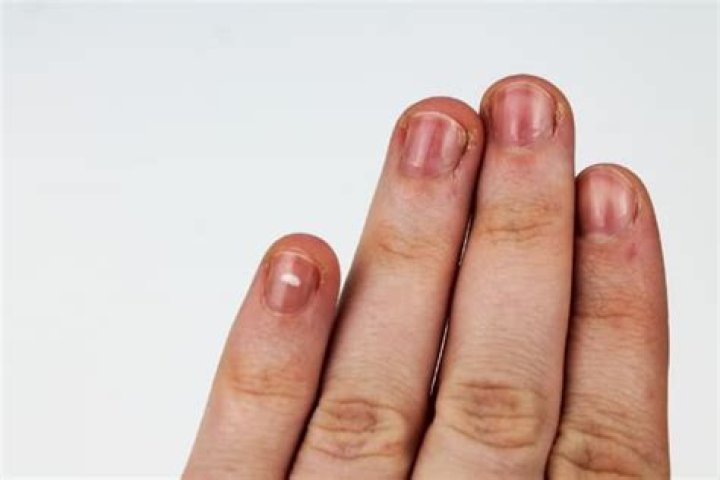 What do red lines under fingernails mean?