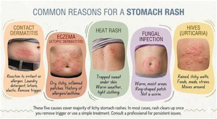 What does a rash on your stomach mean?