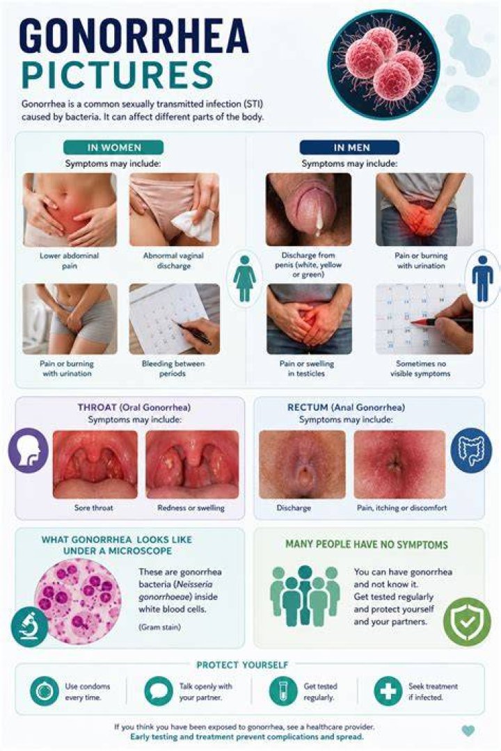 What does gonorrhea look like on a woman?