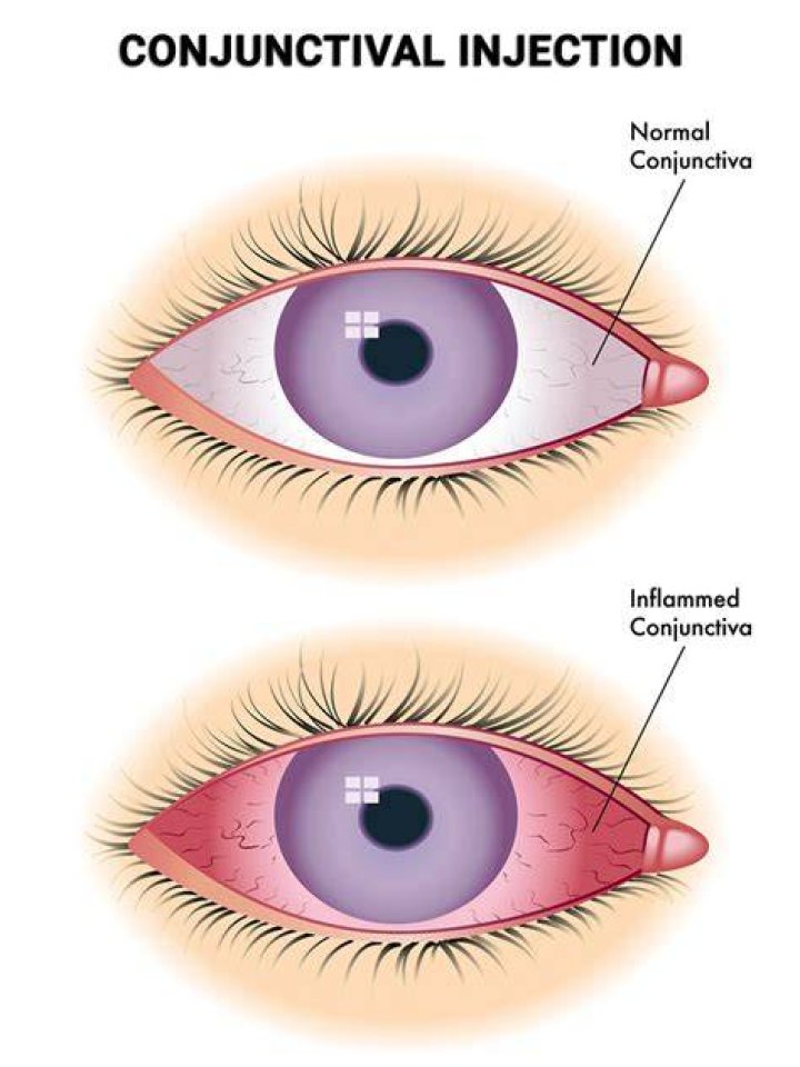 What does it mean when the conjunctiva is injected?