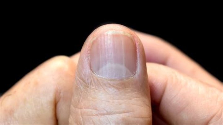 What does it mean when your lunula disappear?