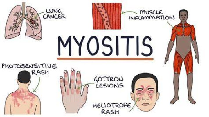 What does myositis rash look like?