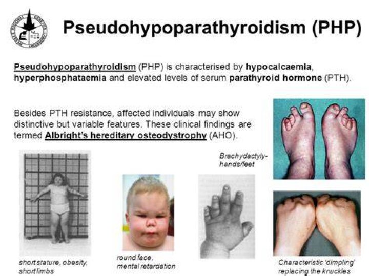 What does Pseudopseudohypoparathyroidism mean?